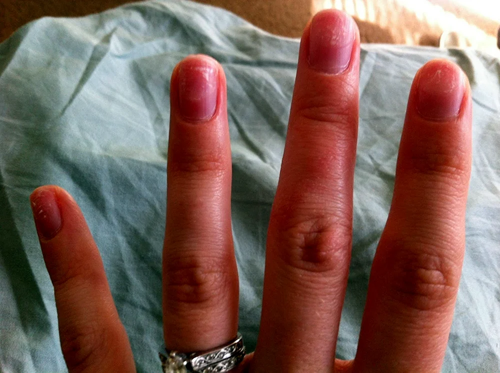 Аллергия на шеллак на пальцах