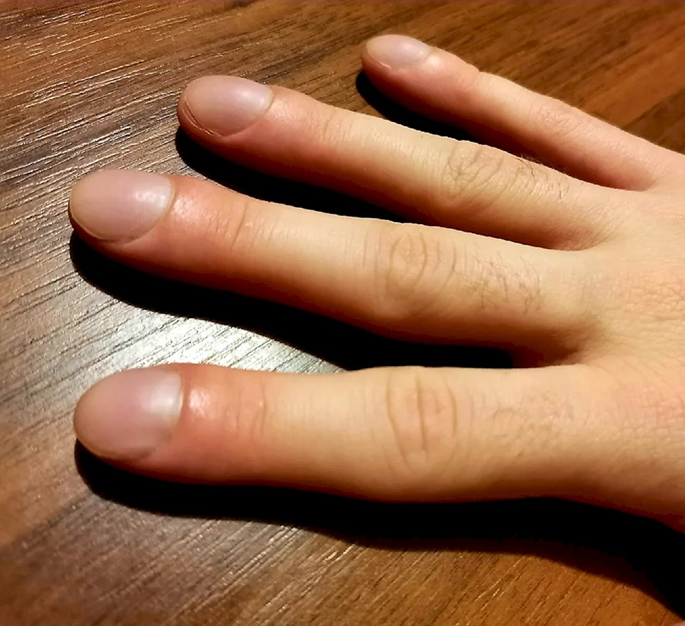 Ногти Гиппократа барабанные пальцы