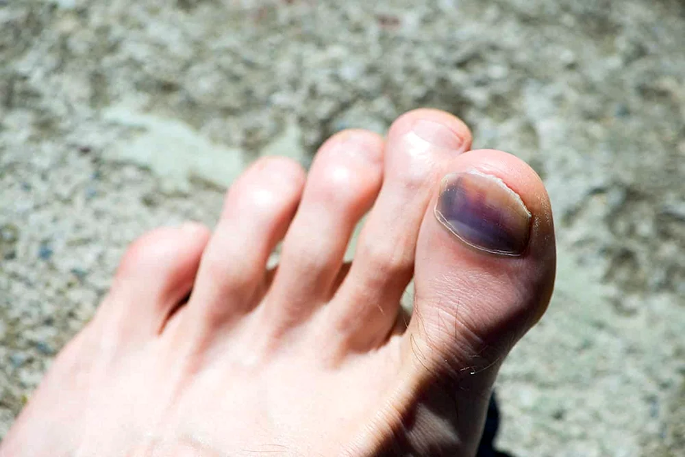 Синие ногти на ногах большие пальцы
